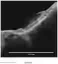 Fig. 08 - Intraoperative topically-applied non-implantable rapid release patch
