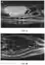 Fig. 04 - Method of treating or preventing tumors of the central nervous system