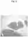 Fig. 04 - COMPOSITION COMPRISING HYDROGEN GAS FOR SUPPRESSION OR PREVENTION OF CANCER METASTASIS