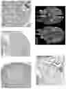 Fig. 05 - Microbiome transplantation