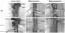 Fig. 01 - Method for treating coronary atherosclerosis and complications thereof