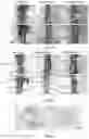 Fig. 02 - Method for treating coronary atherosclerosis and complications thereof