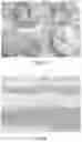 Fig. 07 - Method for treating coronary atherosclerosis and complications thereof