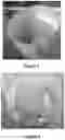 Fig. 03 - PROCESS FOR OBTAINING A FUNCTIONAL DERMAL SUBSTITUTE OF DECELLURIZED AMNIOTIC MEMBRANE FROM THE PLACENTA COMBINATION WITH KERATINOCYTES AND ITS USE AS AN AGENT FOR TISSUE REGENERATION OF THE SKIN