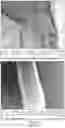 Fig. 09 - BIODEGRADABLE SILK EAR TUBES