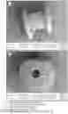 Fig. 10 - BIODEGRADABLE SILK EAR TUBES