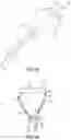 Fig. 06 - Method of removing excess fluid from a patient with hemodilution