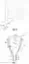 Fig. 08 - Method of removing excess fluid from a patient with hemodilution