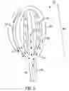 Fig. 09 - Method of removing excess fluid from a patient with hemodilution