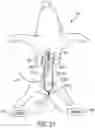 Fig. 25 - Method of removing excess fluid from a patient with hemodilution