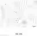 Fig. 30 - Method of removing excess fluid from a patient with hemodilution