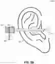 Fig. 04 - MICRO-DISPENSER BASED EAR TREATMENT