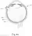 Fig. 06 - Apparatus for subretinal administration of therapeutic agent via a curved needle