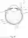 Fig. 08 - Apparatus for subretinal administration of therapeutic agent via a curved needle
