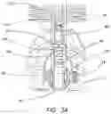 Fig. 04 - Adjustable resuscitation device and method for using the same