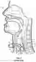 Fig. 02 - Customized Tracheocutaneous Fistula and Tracheostomy Plug