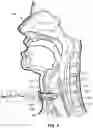 Fig. 03 - Customized Tracheocutaneous Fistula and Tracheostomy Plug