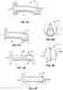 Fig. 06 - Customized Tracheocutaneous Fistula and Tracheostomy Plug