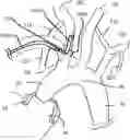 Fig. 01 - Trans-radial access endovascular catheter and method of use