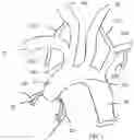 Fig. 02 - Trans-radial access endovascular catheter and method of use