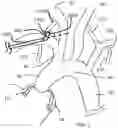 Fig. 03 - Trans-radial access endovascular catheter and method of use
