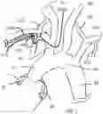 Fig. 04 - Trans-radial access endovascular catheter and method of use