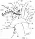 Fig. 05 - Trans-radial access endovascular catheter and method of use
