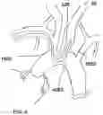 Fig. 06 - Trans-radial access endovascular catheter and method of use