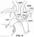 Fig. 07 - Trans-radial access endovascular catheter and method of use