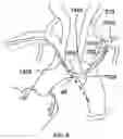 Fig. 09 - Trans-radial access endovascular catheter and method of use