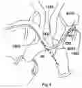 Fig. 10 - Trans-radial access endovascular catheter and method of use