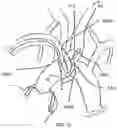 Fig. 11 - Trans-radial access endovascular catheter and method of use