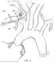Fig. 12 - Trans-radial access endovascular catheter and method of use
