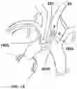 Fig. 15 - Trans-radial access endovascular catheter and method of use