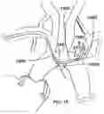 Fig. 16 - Trans-radial access endovascular catheter and method of use