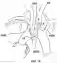 Fig. 17 - Trans-radial access endovascular catheter and method of use