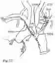 Fig. 18 - Trans-radial access endovascular catheter and method of use