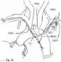 Fig. 19 - Trans-radial access endovascular catheter and method of use