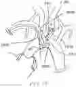 Fig. 20 - Trans-radial access endovascular catheter and method of use