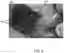 Fig. 10 - Methods for treating cancerous tumors