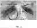 Fig. 14 - Methods for treating cancerous tumors