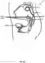Fig. 06 - Electromyographic lead positioning and stimulation titration in a nerve stimulation system for treatment of overactive bladder