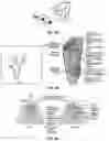 Fig. 17 - Electromyographic lead positioning and stimulation titration in a nerve stimulation system for treatment of overactive bladder