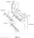 Fig. 20 - Electromyographic lead positioning and stimulation titration in a nerve stimulation system for treatment of overactive bladder