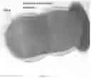 Fig. 32 - Methods and devices for treating vascular related disorders