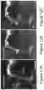 Fig. 16 - Focused Ultrasound Apparatus and Methods of Use