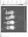 Fig. 15 - Gene therapy for tuberous sclerosis
