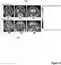 Fig. 10 - Probabilistic atlases of post-treatment multi-parametric MRI scans reveal distinct hemispheric distribution of glioblastoma progression versus pseudo-progression
