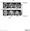 Fig. 11 - Probabilistic atlases of post-treatment multi-parametric MRI scans reveal distinct hemispheric distribution of glioblastoma progression versus pseudo-progression