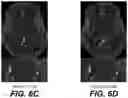 Fig. 09 - Neural network evolution using expedited genetic algorithm for medical image denoising